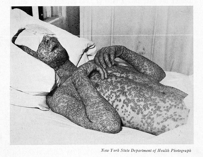 Smallpox victim