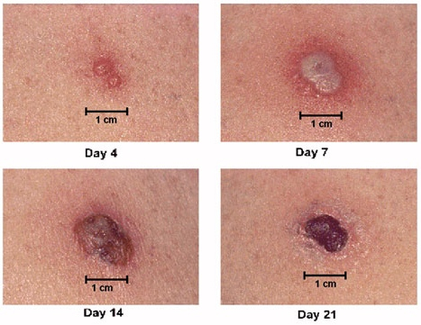 Smallpox primary vaccine site reaction